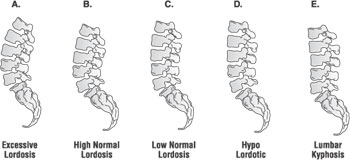 腰椎の前弯の比較図