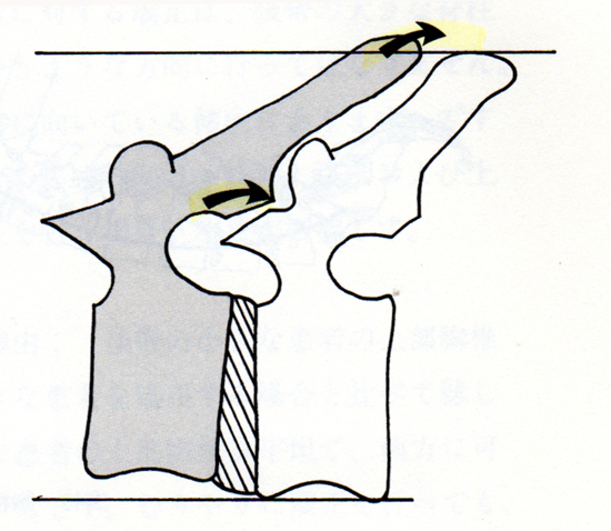 胸椎5番が後方にズレた図の腹臥位像