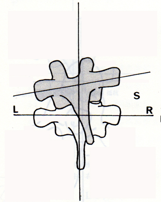胸椎5番が後方・右回旋・左側屈にズレた図